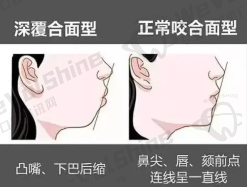 牙齿矫正价格
